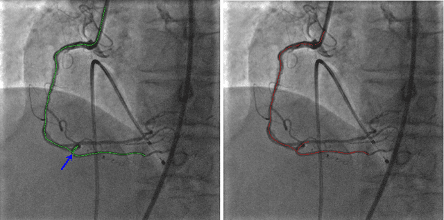 Figure 3 for VOIDD: automatic vessel of intervention dynamic detection in PCI procedures