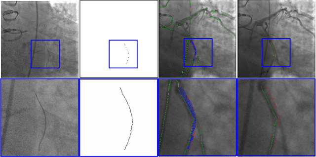Figure 1 for VOIDD: automatic vessel of intervention dynamic detection in PCI procedures