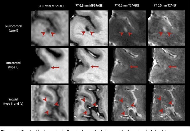 Figure 1 for Cortical lesions, central vein sign, and paramagnetic rim lesions in multiple sclerosis: emerging machine learning techniques and future avenues