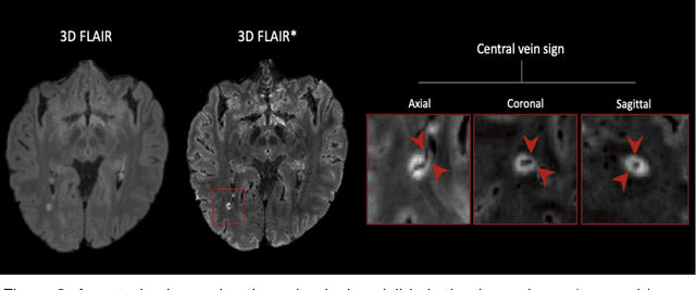 Figure 3 for Cortical lesions, central vein sign, and paramagnetic rim lesions in multiple sclerosis: emerging machine learning techniques and future avenues