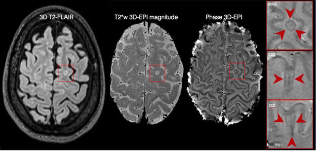 Figure 4 for Cortical lesions, central vein sign, and paramagnetic rim lesions in multiple sclerosis: emerging machine learning techniques and future avenues