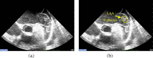 Figure 2 for An algorithm for Left Atrial Thrombi detection using Transesophageal Echocardiography