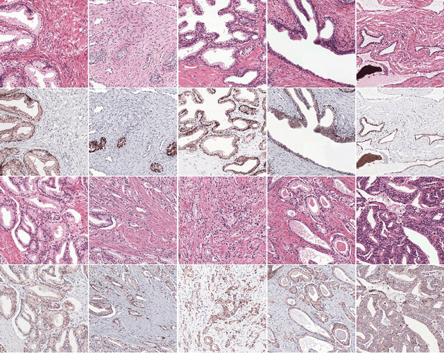 Figure 3 for Epithelium segmentation using deep learning in H&E-stained prostate specimens with immunohistochemistry as reference standard