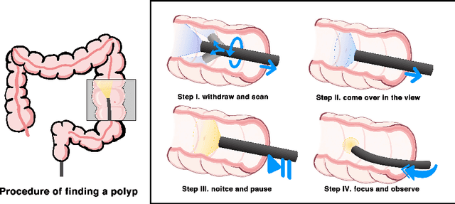 Figure 1 for Colonoscopy Polyp Detection: Domain Adaptation From Medical Report Images to Real-time Videos