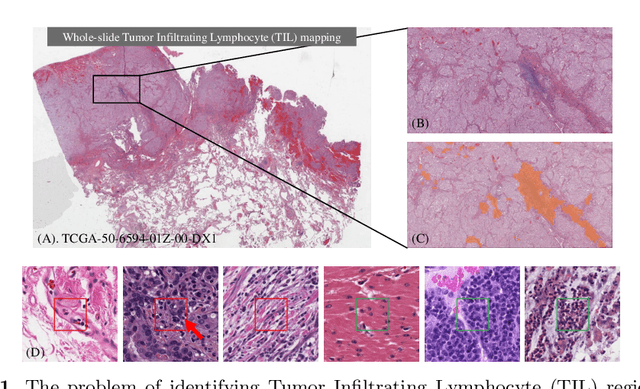 Figure 1 for Learning from Thresholds: Fully Automated Classification of Tumor Infiltrating Lymphocytes for Multiple Cancer Types