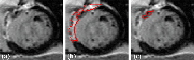 Figure 1 for Three-Dimensional Segmentation of the Left Ventricle in Late Gadolinium Enhanced MR Images of Chronic Infarction Combining Long- and Short-Axis Information