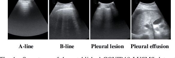 Figure 1 for Semi-Supervised Active Learning for COVID-19 Lung Ultrasound Multi-symptom Classification