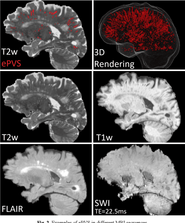 Figure 3 for Deep Learning Based Detection of Enlarged Perivascular Spaces on Brain MRI