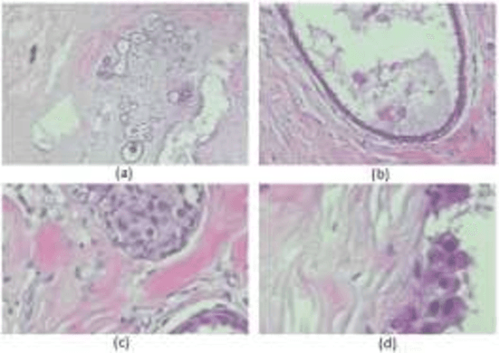 Figure 3 for Breast Cancer Detection using Histopathological Images
