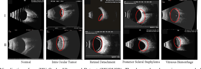 Figure 1 for CDNet: Contrastive Disentangled Network for Fine-Grained Image Categorization of Ocular B-Scan Ultrasound
