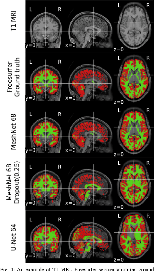 Figure 4 for End-to-end learning of brain tissue segmentation from imperfect labeling