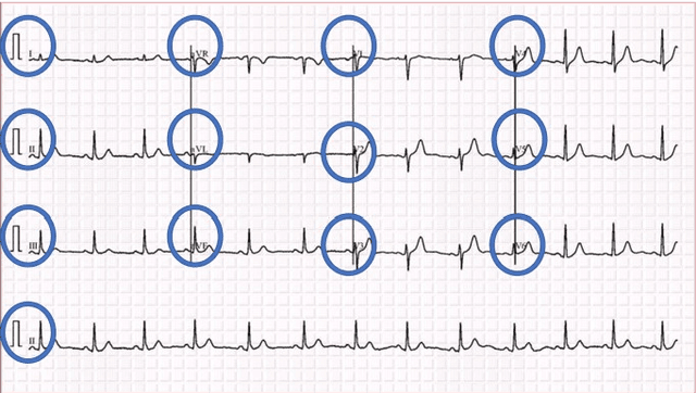 Figure 1 for COVID-19 Electrocardiograms Classification using CNN Models