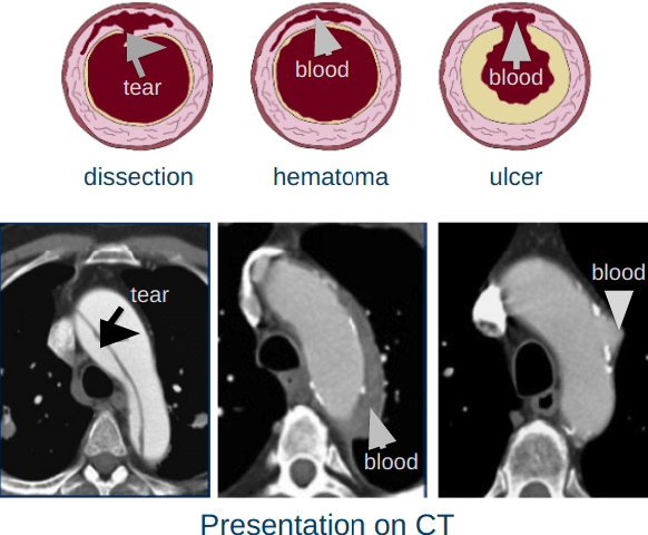 Figure 1 for Deep Learning based detection of Acute Aortic Syndrome in contrast CT images