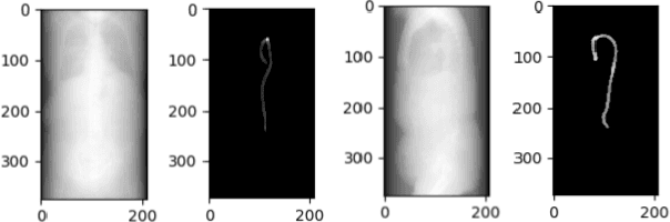 Figure 3 for Deep Learning based detection of Acute Aortic Syndrome in contrast CT images