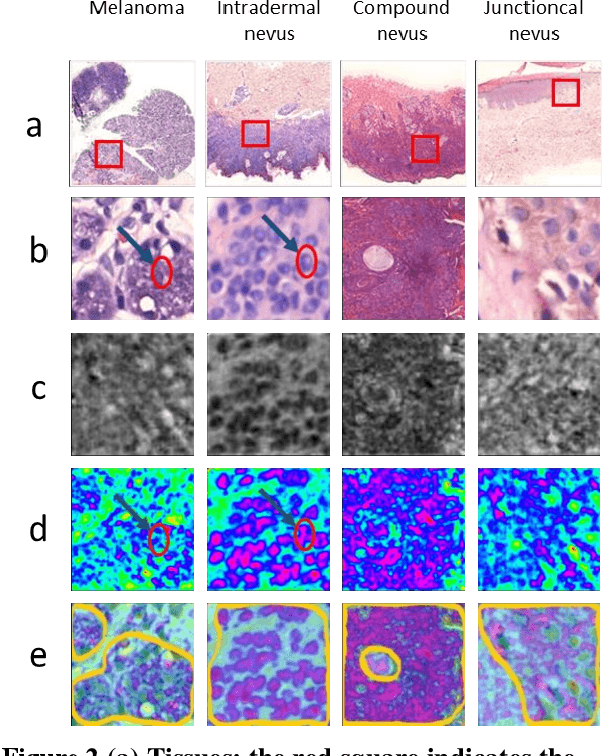 Figure 4 for Interpretable Classification from Skin Cancer Histology Slides Using Deep Learning: A Retrospective Multicenter Study