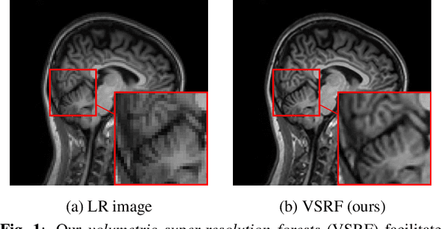 Figure 1 for Learning from a Handful Volumes: MRI Resolution Enhancement with Volumetric Super-Resolution Forests