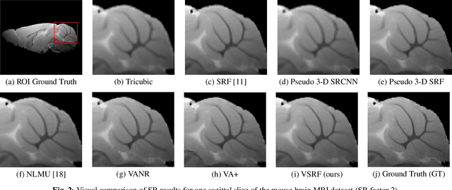 Figure 3 for Learning from a Handful Volumes: MRI Resolution Enhancement with Volumetric Super-Resolution Forests