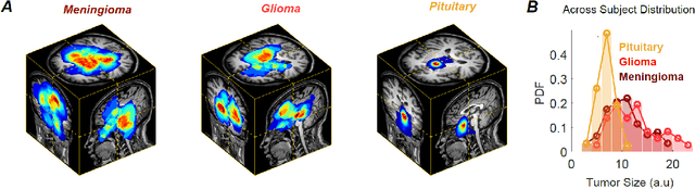 Figure 4 for QuickTumorNet: Fast Automatic Multi-Class Segmentation of Brain Tumors