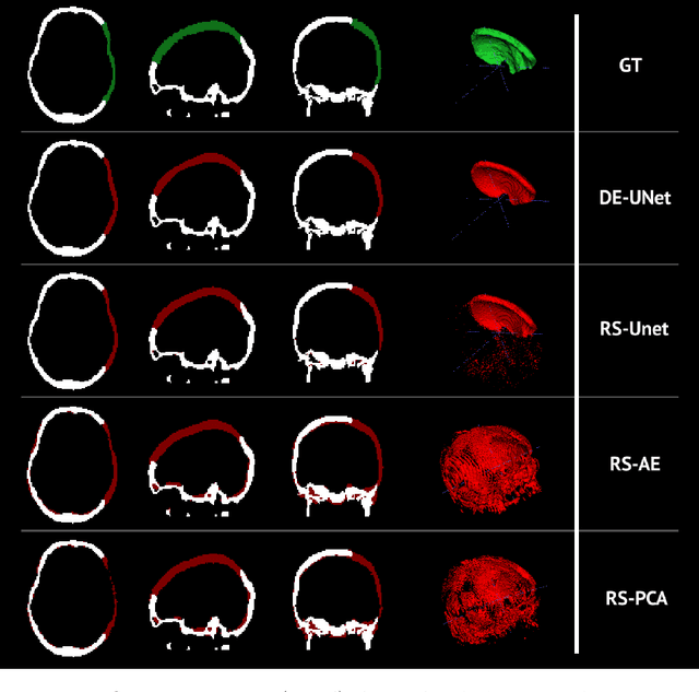 Figure 3 for Self-supervised Skull Reconstruction in Brain CT Images with Decompressive Craniectomy