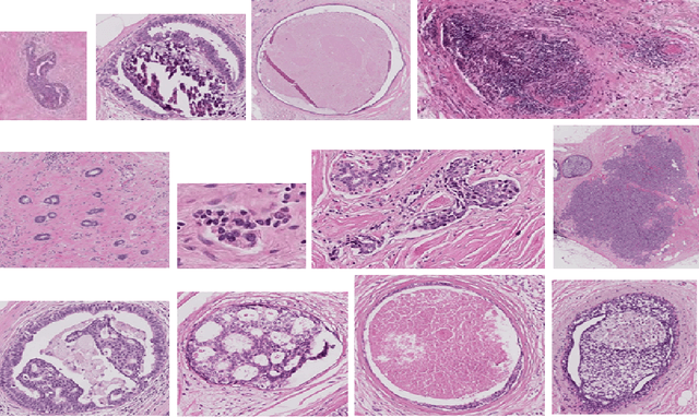 Figure 1 for Bag of Visual Words  with Deep Features -- Patch Classification Model for Limited Dataset of Breast Tumours