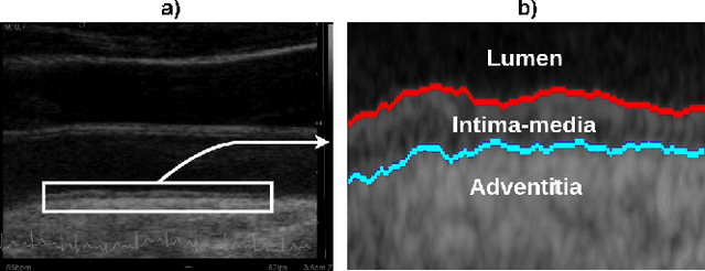 Figure 1 for Carotid artery wall segmentation in ultrasound image sequences using a deep convolutional neural network