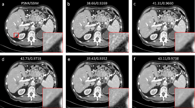 Figure 3 for Low-Dose CT Using Denoising Diffusion Probabilistic Model for 20$\times$ Speedup