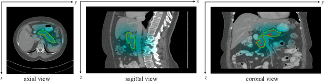 Figure 1 for Globally Guided Progressive Fusion Network for 3D Pancreas Segmentation