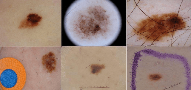 Figure 1 for Skin Lesion Classification Using Hybrid Deep Neural Networks
