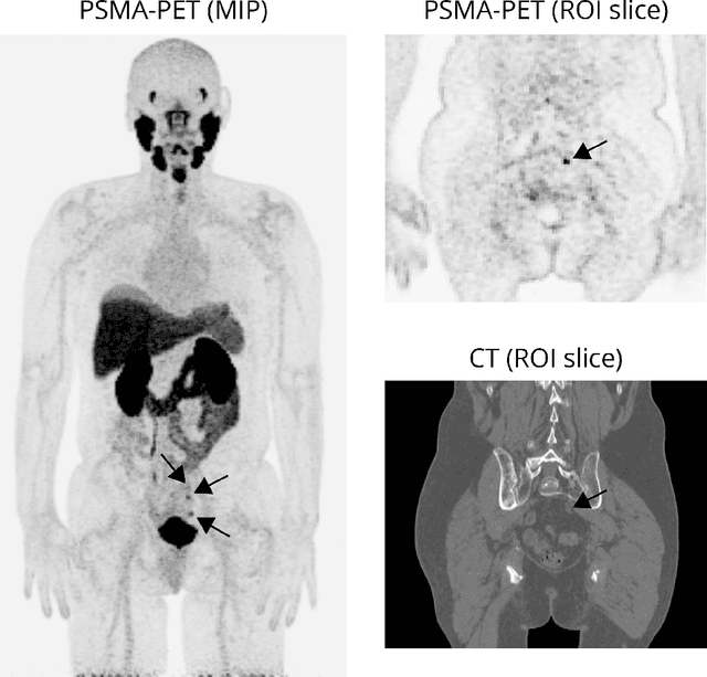 Figure 1 for Multi-modal volumetric concept activation to explain detection and classification of metastatic prostate cancer on PSMA-PET/CT