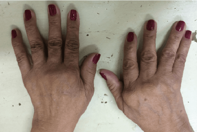 Figure 1 for Hand range of motion evaluation for Rheumatoid Arthritis patients