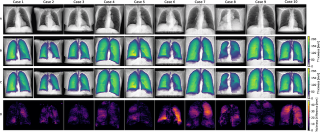 Figure 3 for Per-Pixel Lung Thickness and Lung Capacity Estimation on Chest X-Rays using Convolutional Neural Networks