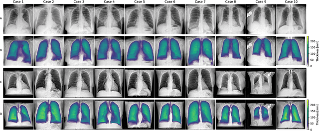 Figure 4 for Per-Pixel Lung Thickness and Lung Capacity Estimation on Chest X-Rays using Convolutional Neural Networks