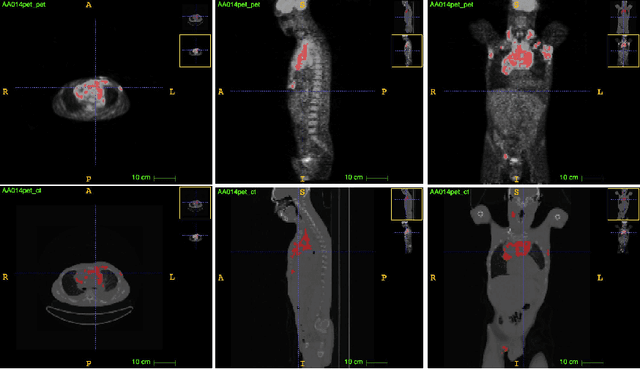 Figure 1 for Deep PET/CT fusion with Dempster-Shafer theory for lymphoma segmentation