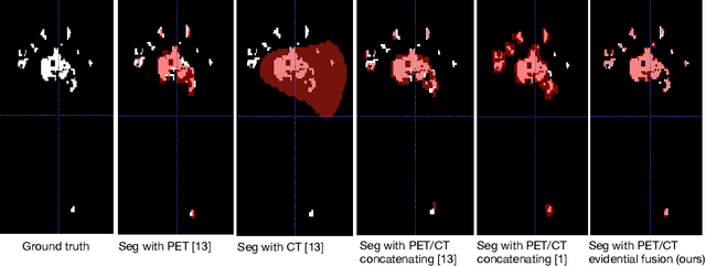 Figure 4 for Deep PET/CT fusion with Dempster-Shafer theory for lymphoma segmentation