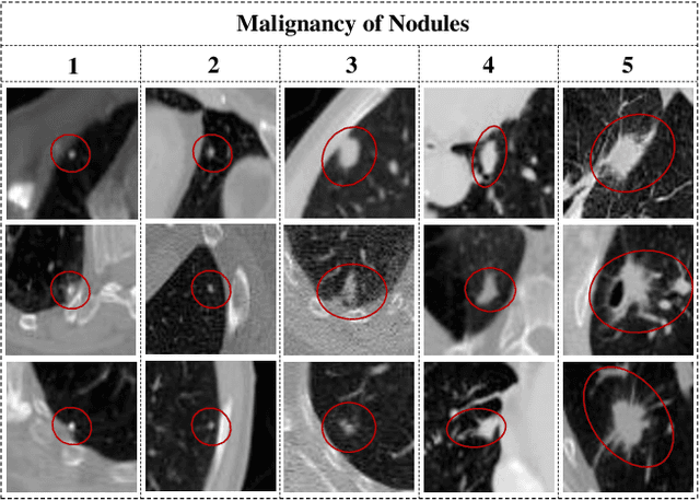Figure 1 for Learning from Ambiguous Labels for Lung Nodule Malignancy Prediction