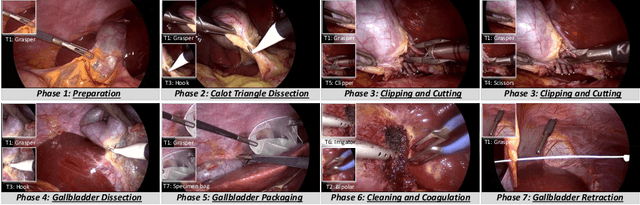 Figure 1 for Multi-Task Recurrent Convolutional Network with Correlation Loss for Surgical Video Analysis