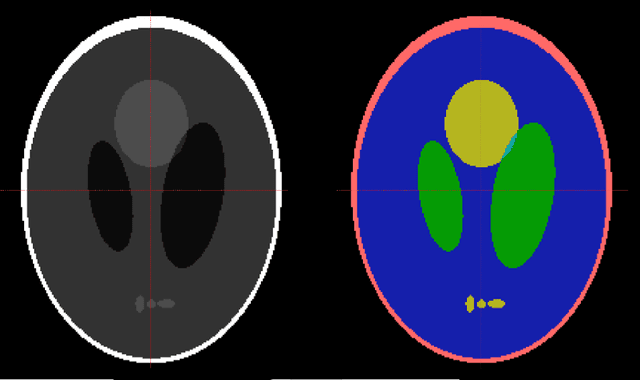 Figure 1 for Reducing the Gibbs effect in multimodal medical imaging by the Fake Nodes Approach