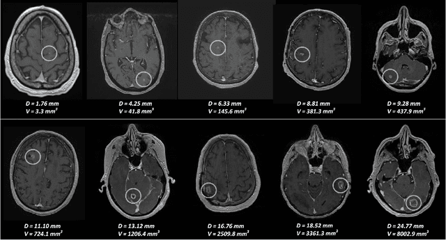 Figure 1 for Augmented Networks for Faster Brain Metastases Detection in T1-Weighted Contrast-Enhanced 3D MRI