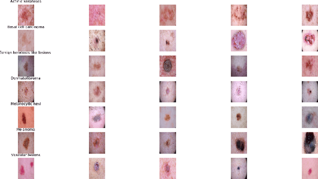 Figure 4 for Skin Cancer Classification using Inception Network and Transfer Learning