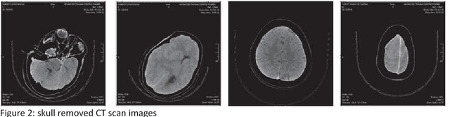 Figure 3 for An Automatic Method for Complete Brain Matter Segmentation from Multislice CT scan