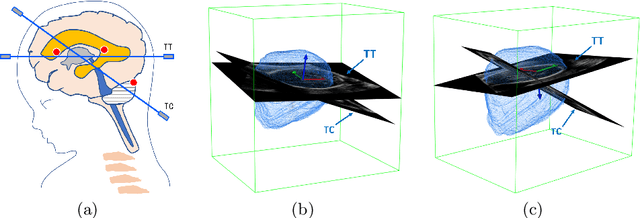 Figure 1 for Agent with Warm Start and Active Termination for Plane Localization in 3D Ultrasound