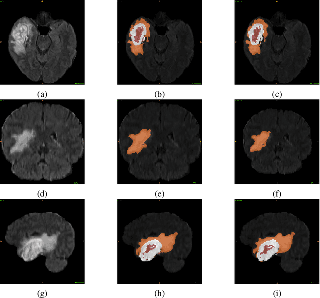 Figure 1 for Glioblastoma Multiforme Patient Survival Prediction