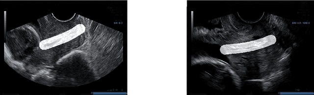 Figure 1 for Spontaneous preterm birth prediction using convolutional neural networks