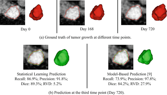 Figure 4 for Personalized Pancreatic Tumor Growth Prediction via Group Learning