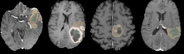 Figure 3 for Top 10 BraTS 2020 challenge solution: Brain tumor segmentation with self-ensembled, deeply-supervised 3D-Unet like neural networks