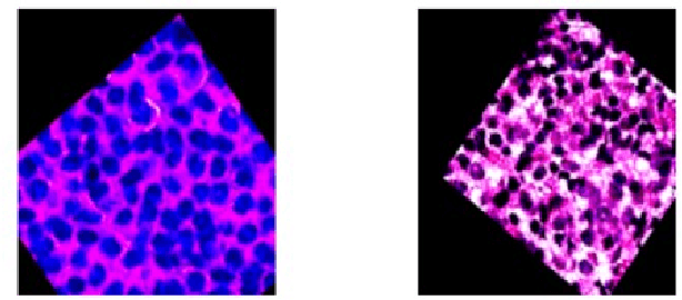 Figure 3 for Transformation Invariant Cancerous Tissue Classification Using Spatially Transformed DenseNet