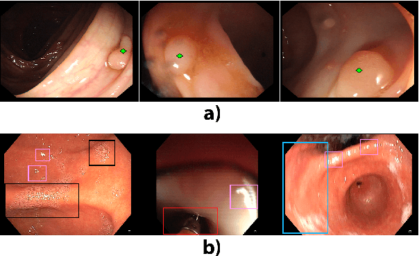 Figure 1 for A learning without forgetting approach to incorporate artifact knowledge in polyp localization tasks