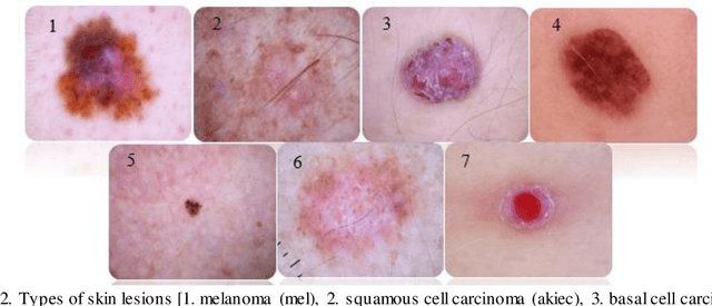 Figure 3 for DenseNet approach to segmentation and classification of dermatoscopic skin lesions images