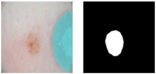 Figure 2 for Skin Lesion Analysis Toward Melanoma Detection: A Challenge at the 2017 International Symposium on Biomedical Imaging (ISBI), Hosted by the International Skin Imaging Collaboration (ISIC)