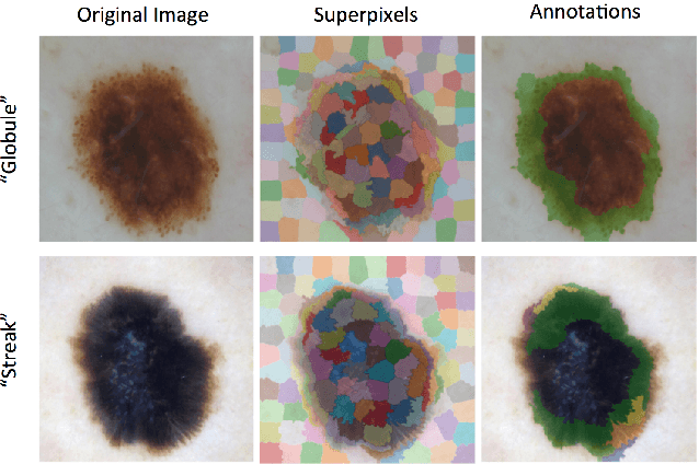 Figure 3 for Skin Lesion Analysis toward Melanoma Detection: A Challenge at the International Symposium on Biomedical Imaging (ISBI) 2016, hosted by the International Skin Imaging Collaboration (ISIC)